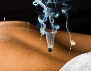 Moxibustion with Sue Fittell